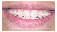 ceramic-braces ceramic-braces