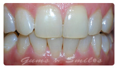 healthy-gums healthy-gums