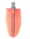 implant-od01 implant-od01