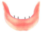implant-od02 implant-od02