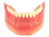 implant-od03 implant-od03