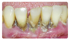 infected-gums infected-gums