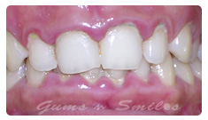 inflamed-gums