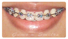metal-braces metal-braces