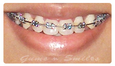 metal-braces