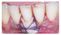 soft-tissuegraft