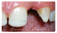 teeth-hour-before