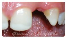 teeth-hour-before teeth-hour-before