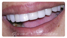 tooth-veneers-after01 tooth-veneers-after01
