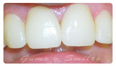 tooth-veneers-after02 tooth-veneers-after02