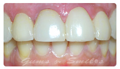 tooth-veneers-after03-final