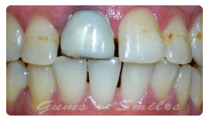 tooth-veneers-after03 tooth-veneers-after03