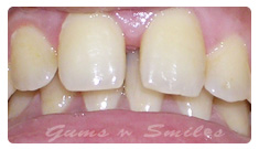 tooth-veneers-before02 tooth-veneers-before02