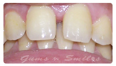 tooth-veneers-before02