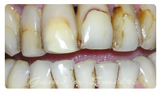 tooth-veneers-before03
