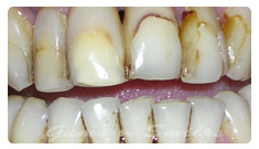 tooth-veneers-before03 tooth-veneers-before03